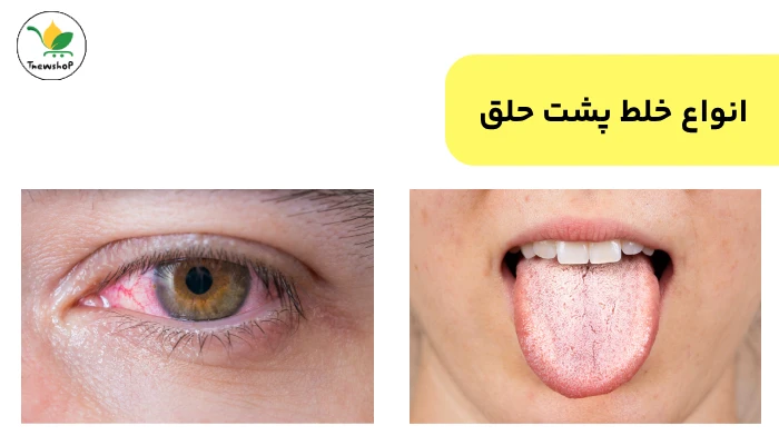 درمان خلط پشت حلق در طب سنتی