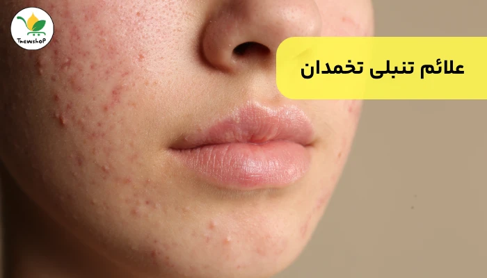 علائم تنبلی تخمدان