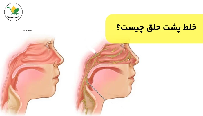 درمان خانگی خلط پشت حلق