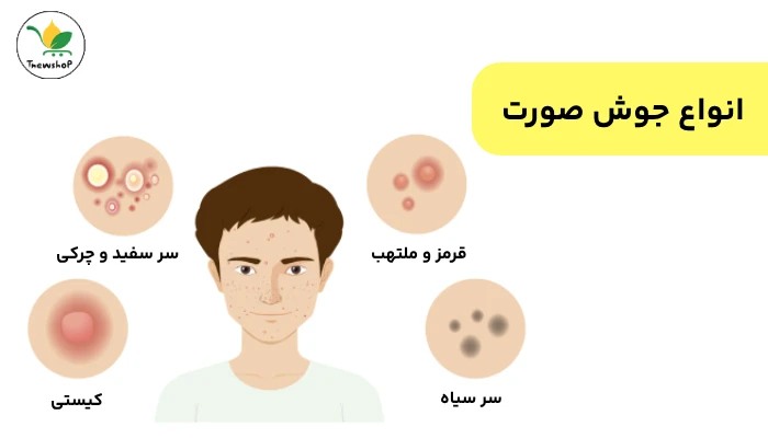 انواع جوش صورت