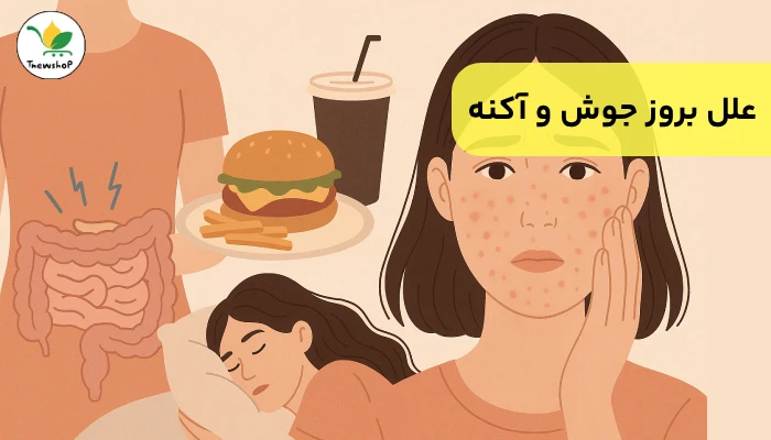 علت جوش و آکنه